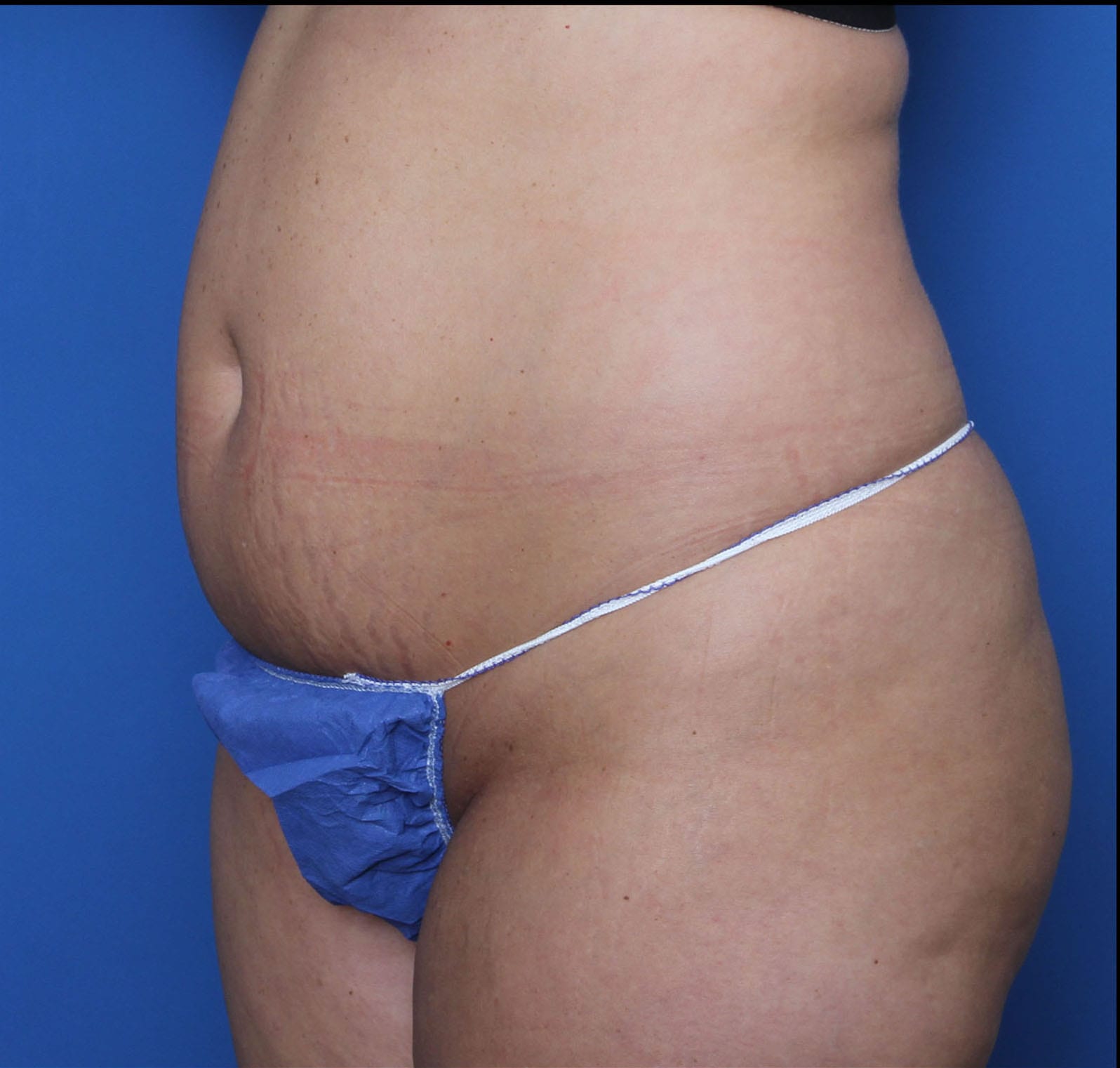 Tummy Tuck Patient Photo - Case 8850 - before view-3