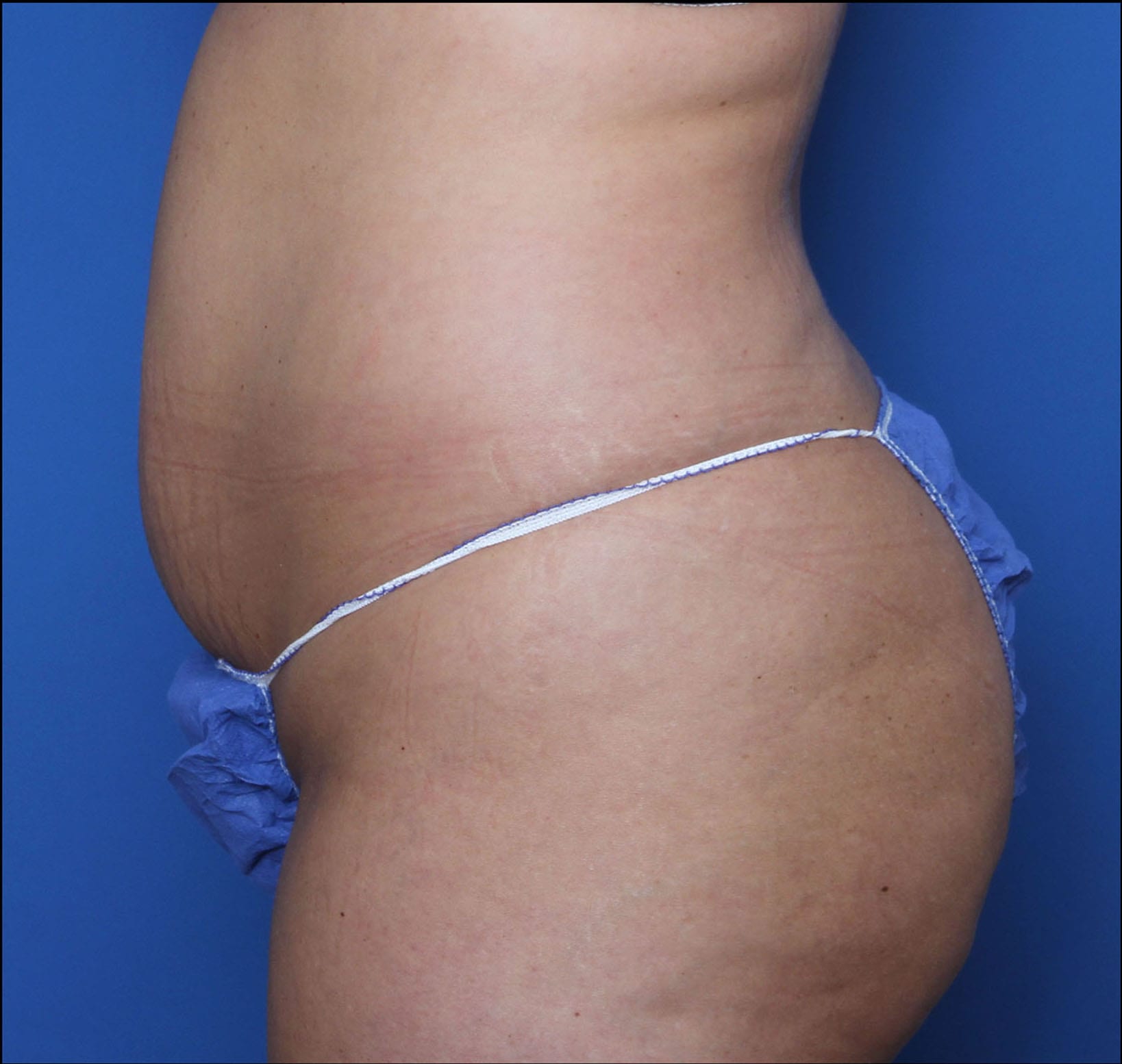 Tummy Tuck Patient Photo - Case 8850 - before view-2