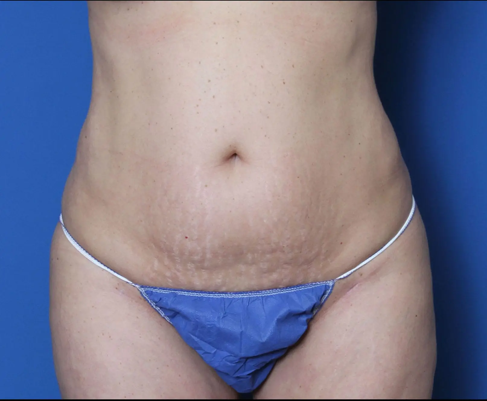 Tummy Tuck Patient Photo - Case 8850 - after view-0