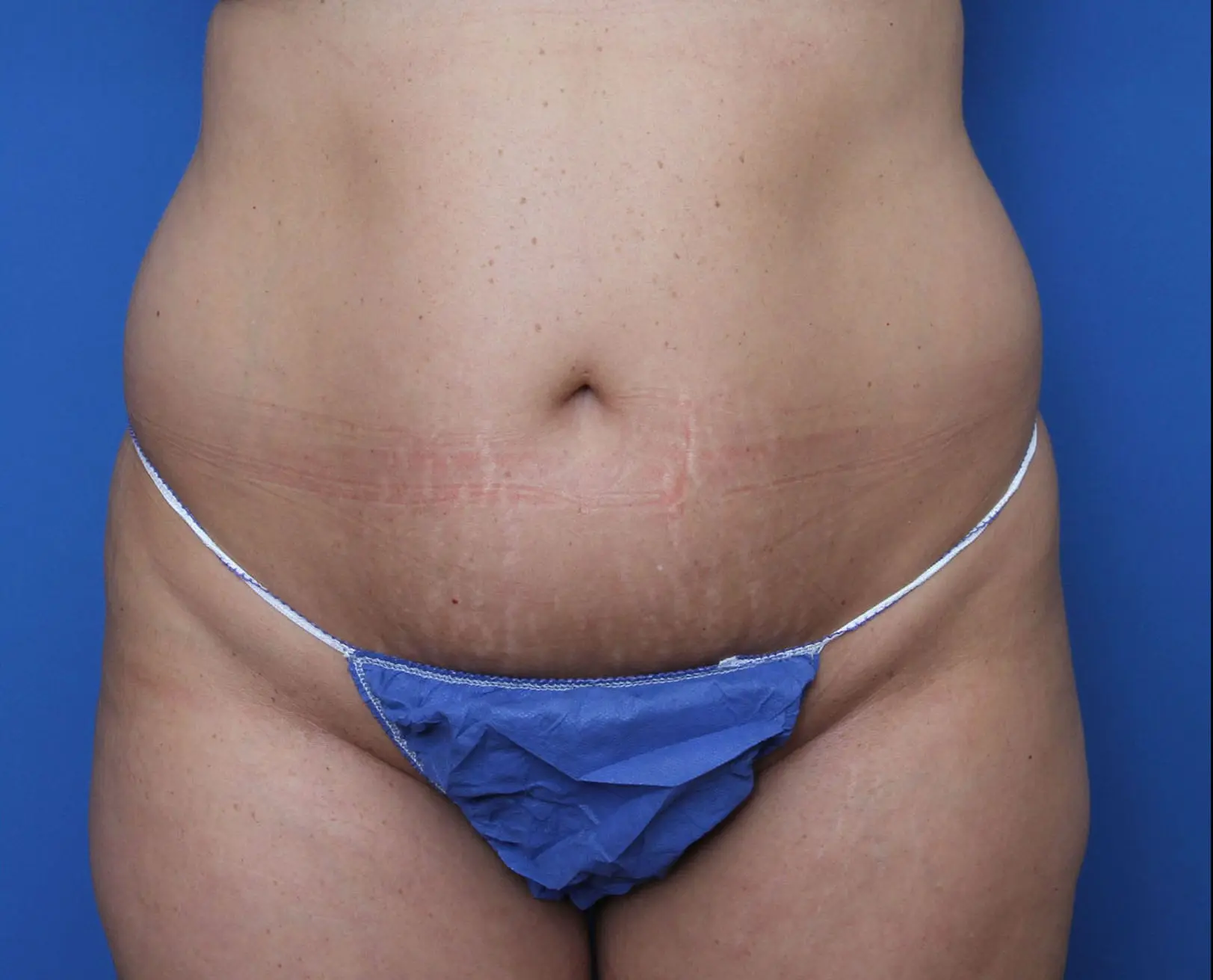 Tummy Tuck Patient Photo - Case 8850 - before view-0