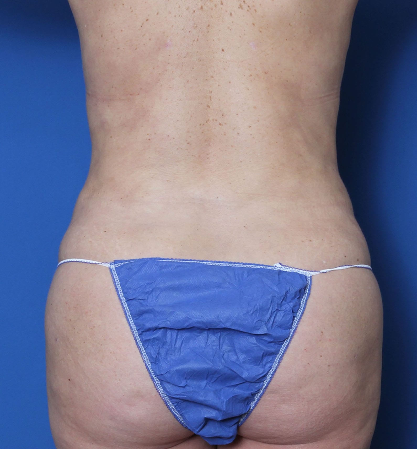 Tummy Tuck Patient Photo - Case 8850 - before view-1