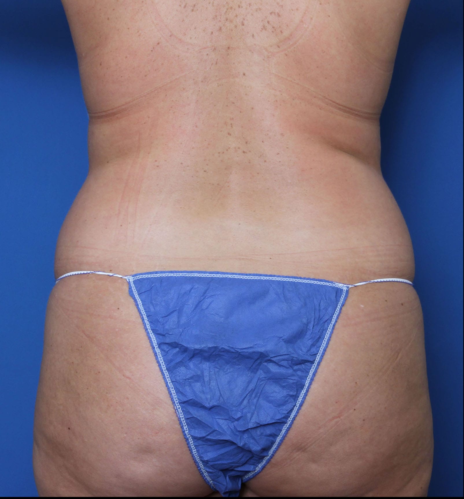 Tummy Tuck Patient Photo - Case 8850 - after view-1