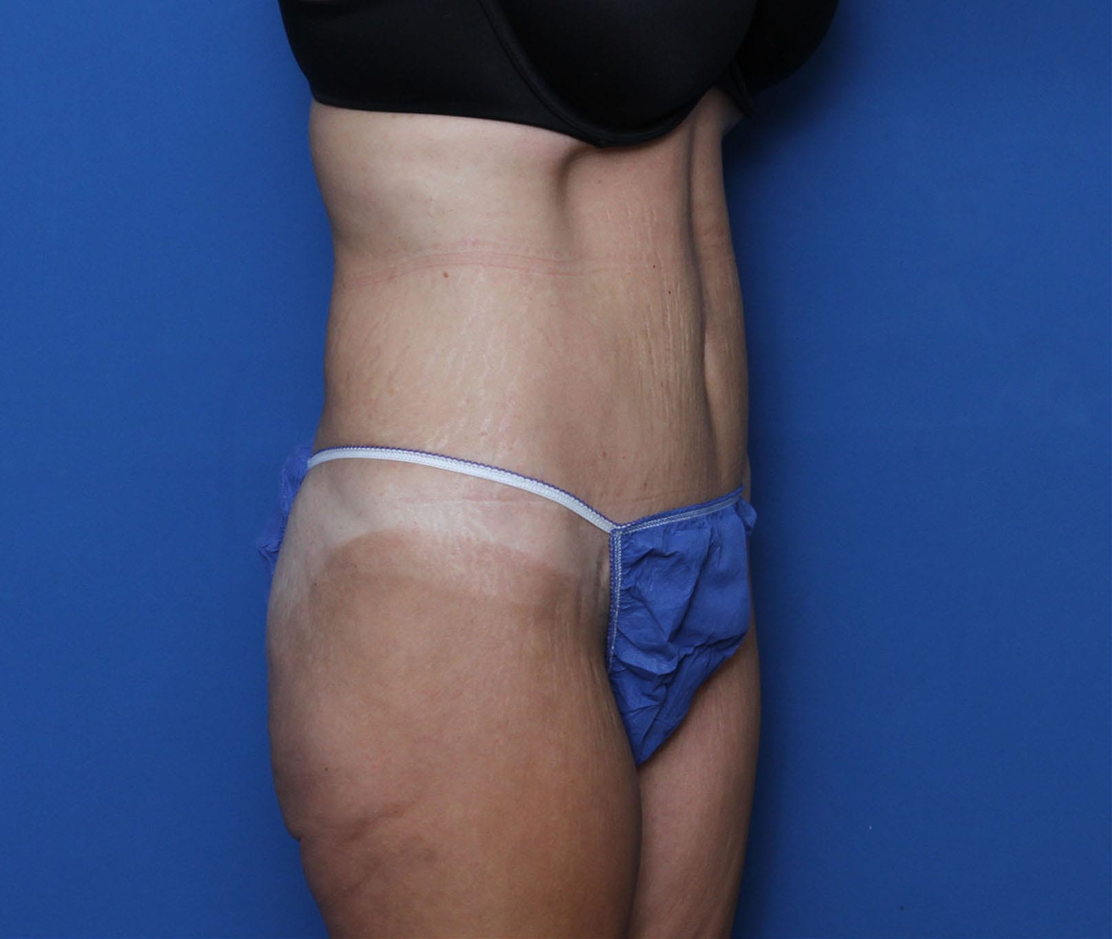 Tummy Tuck Patient Photo - Case 9773 - after view-2
