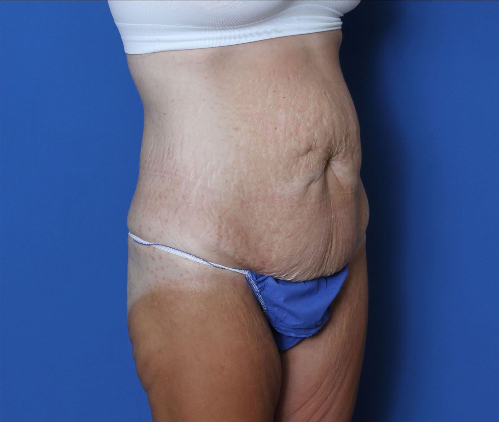 Tummy Tuck Patient Photo - Case 9773 - before view-2