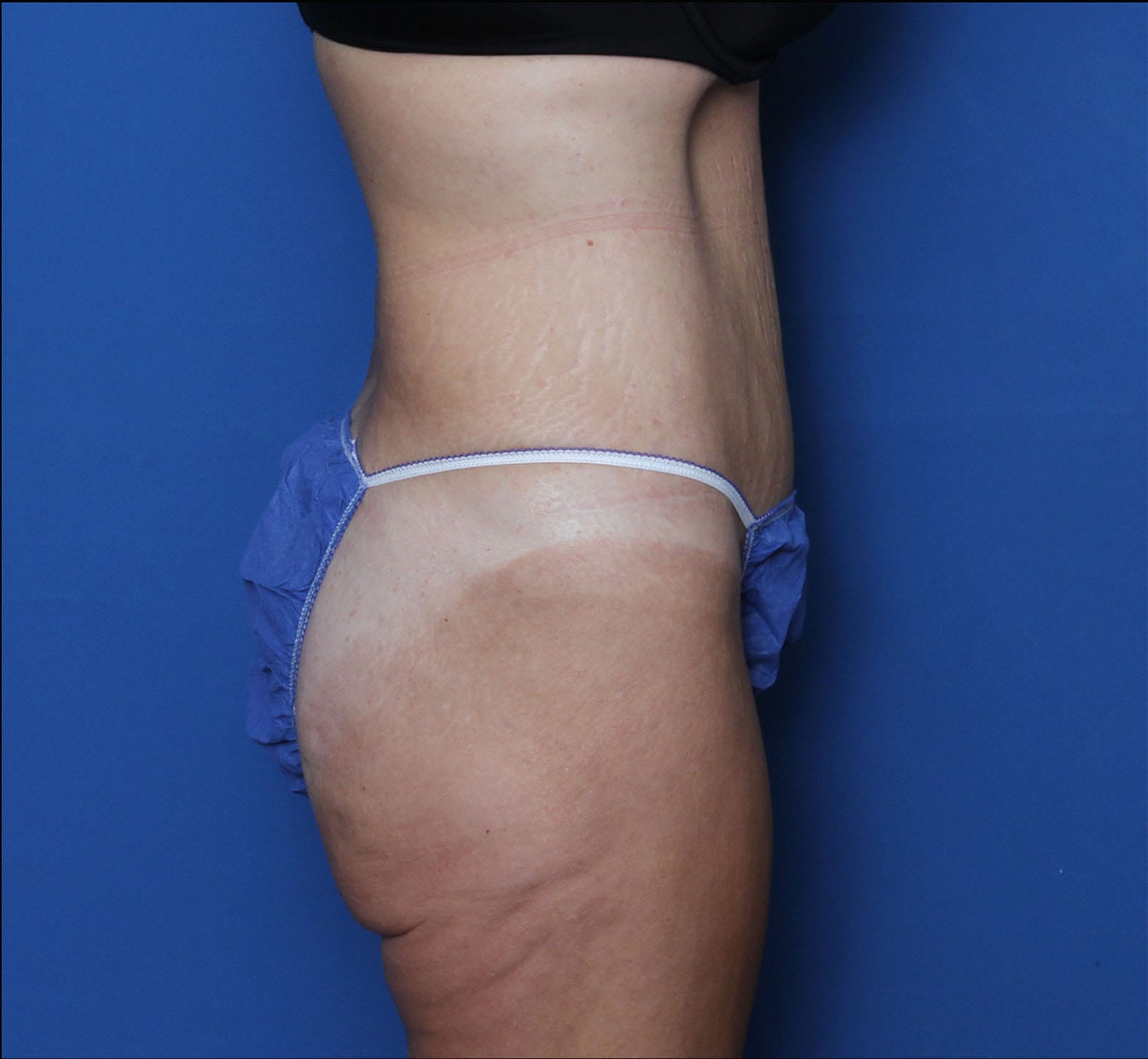 Tummy Tuck Patient Photo - Case 9773 - after view-1