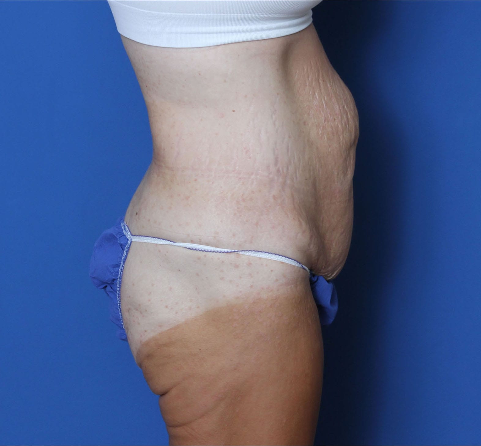 Tummy Tuck Patient Photo - Case 9773 - before view-1