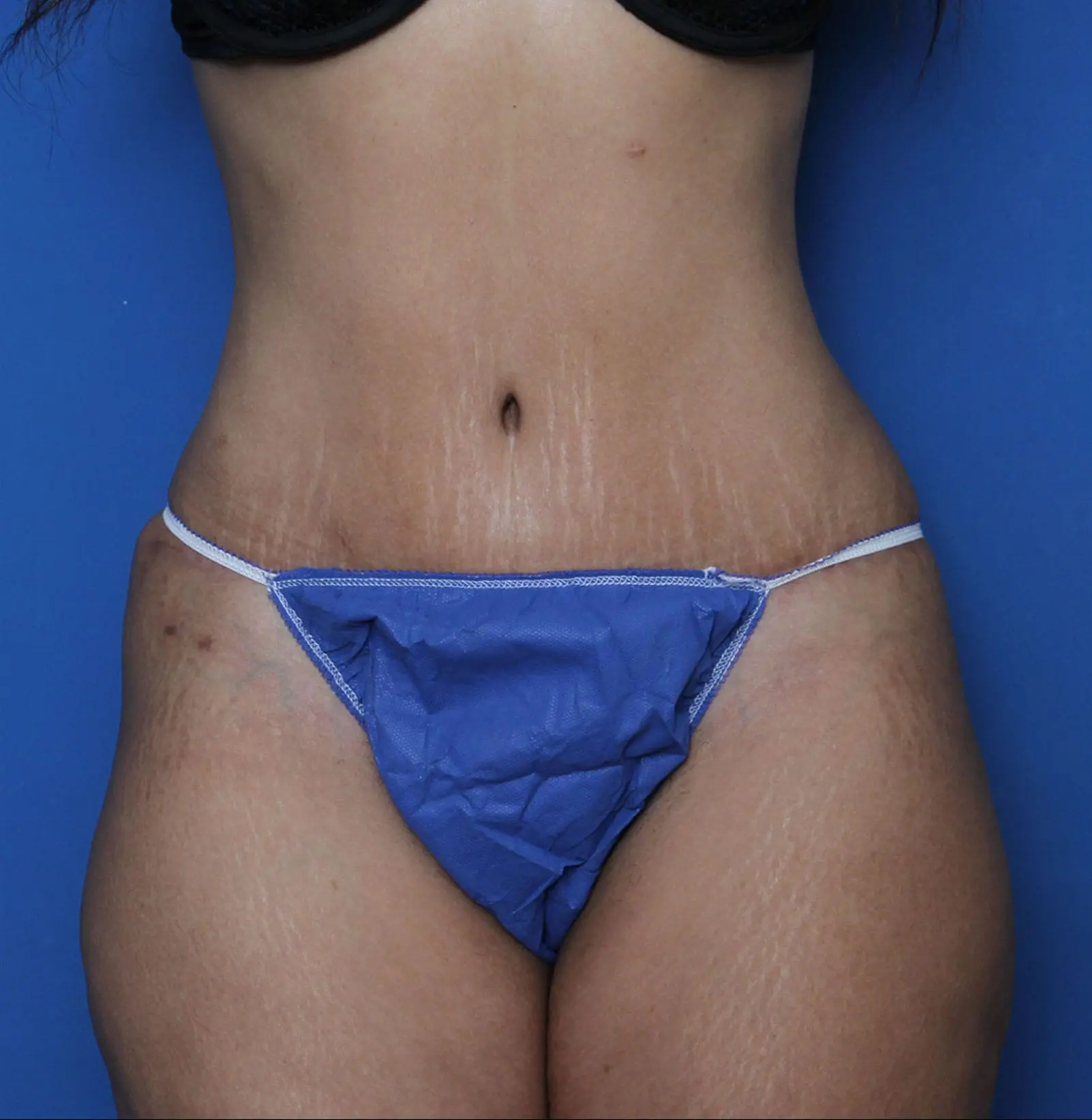 Tummy Tuck Patient Photo - Case MM5921 - after view