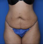 Tummy Tuck - Case MM5921 - Before