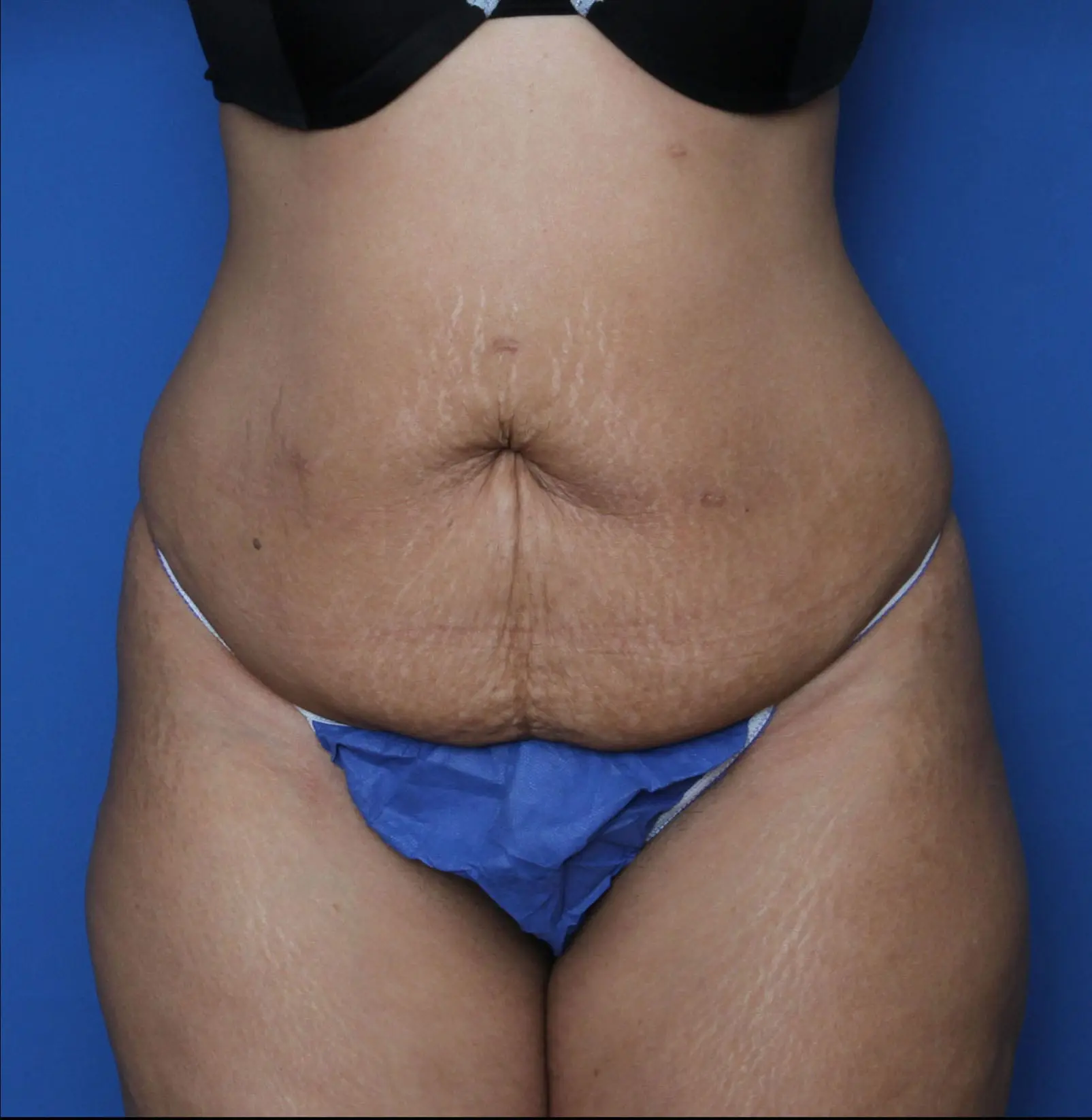Tummy Tuck Patient Photo - Case MM5921 - before view-