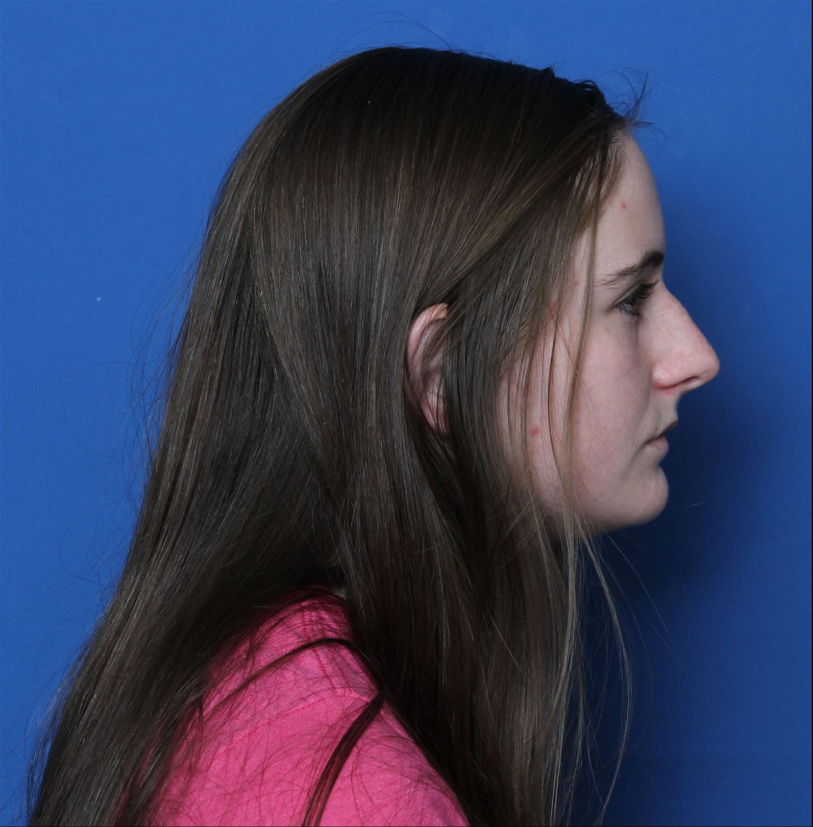 Rhinoplasty Patient Photo - Case 1774 - before view-1