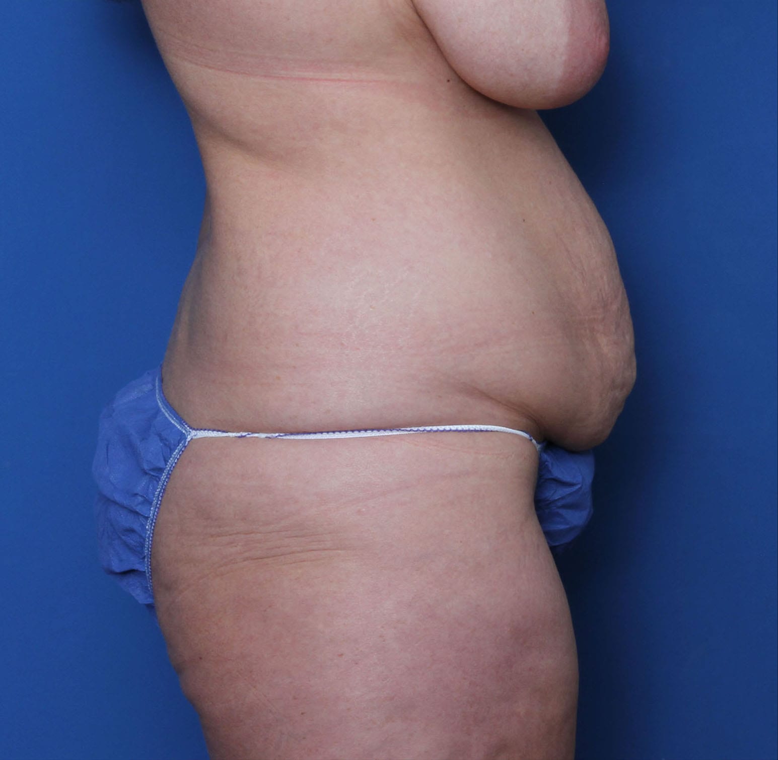 Liposuction Patient Photo - Case MM5198 - before view-2