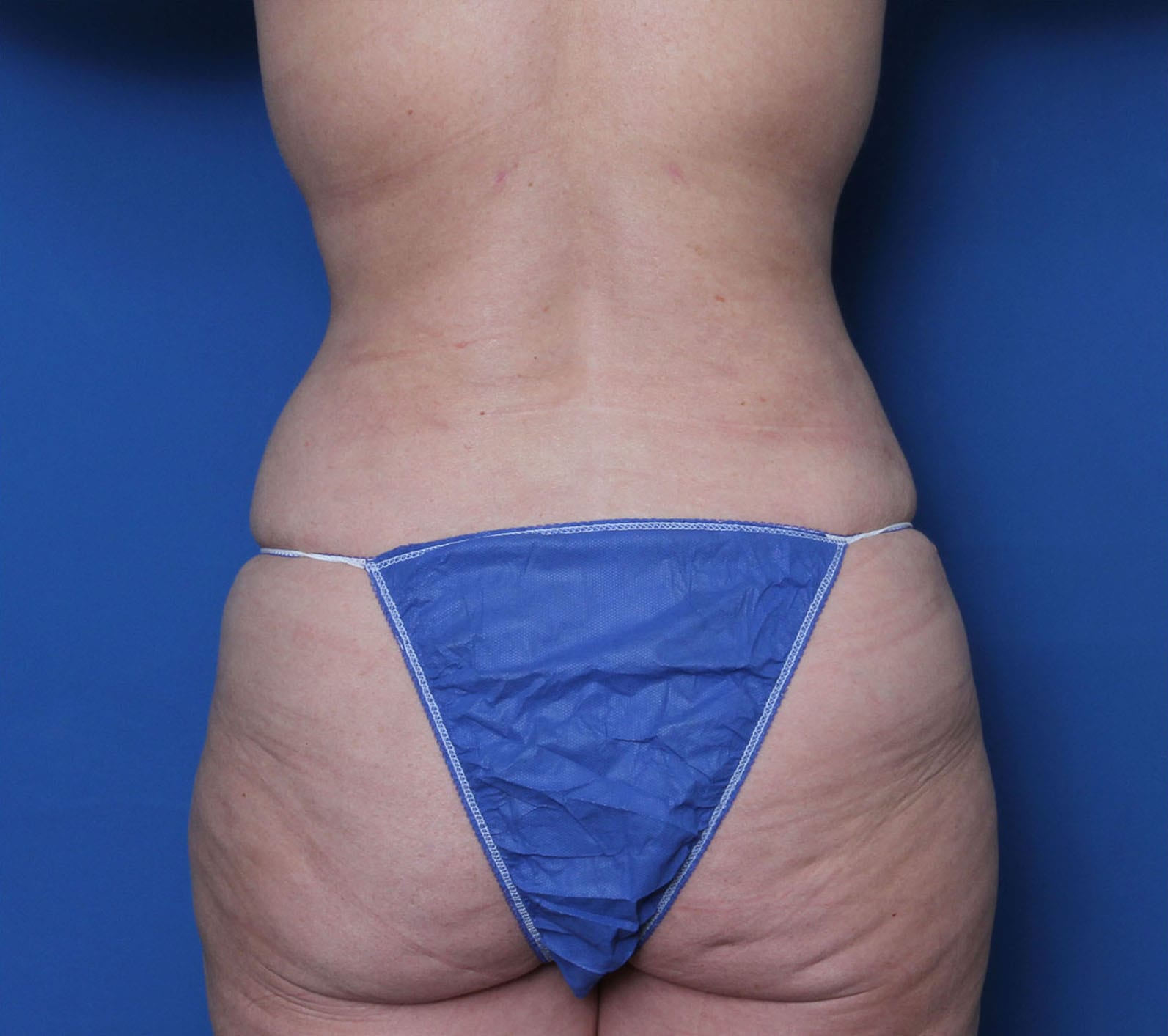 Liposuction Patient Photo - Case MM5198 - before view-1