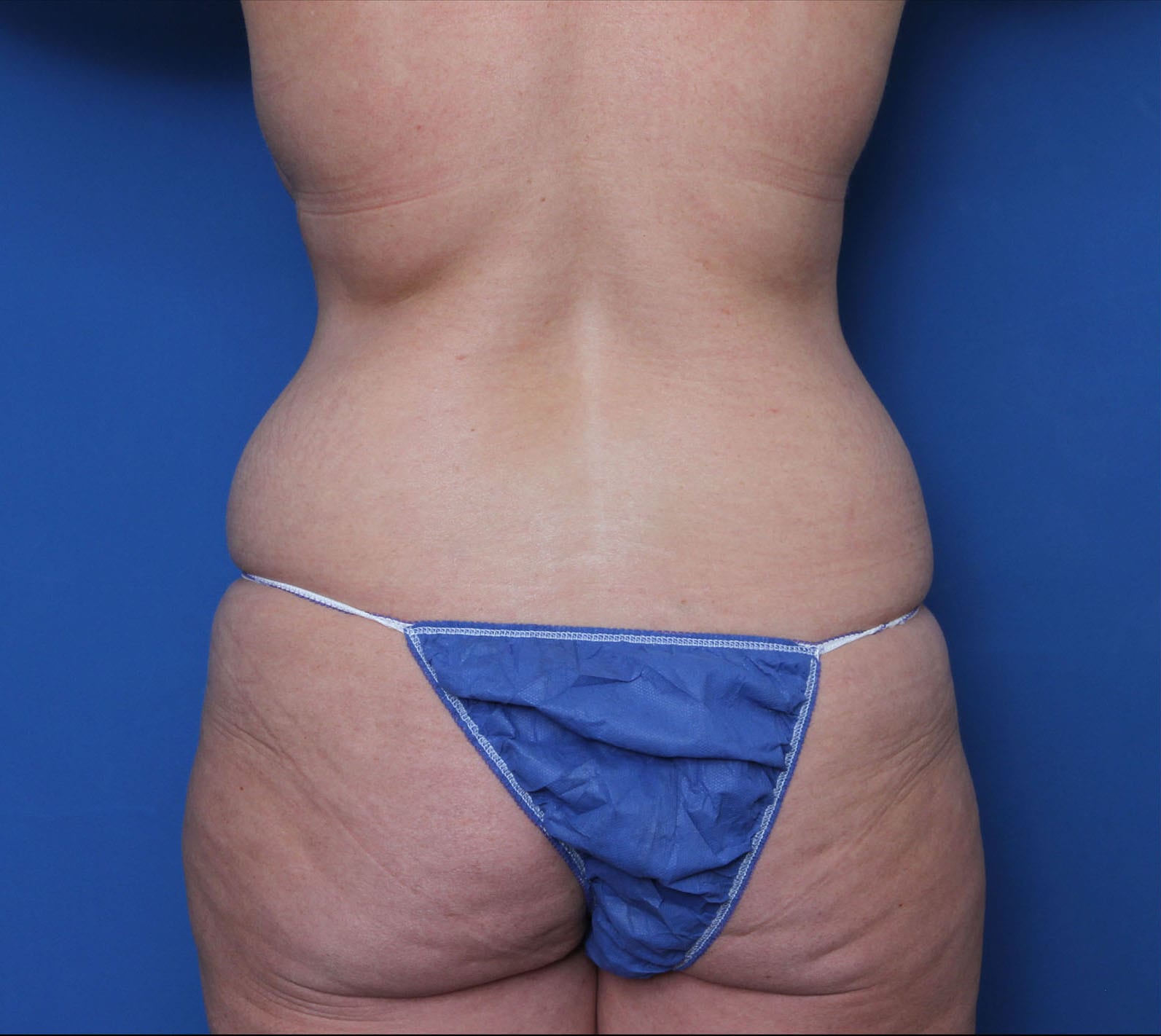 Liposuction Patient Photo - Case MM5198 - after view-1