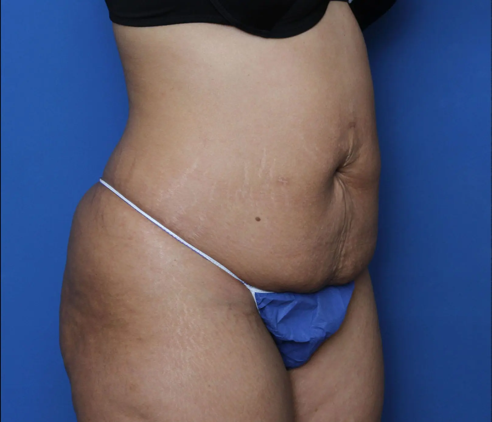 Tummy Tuck Patient Photo - Case MM5921 - before view-2