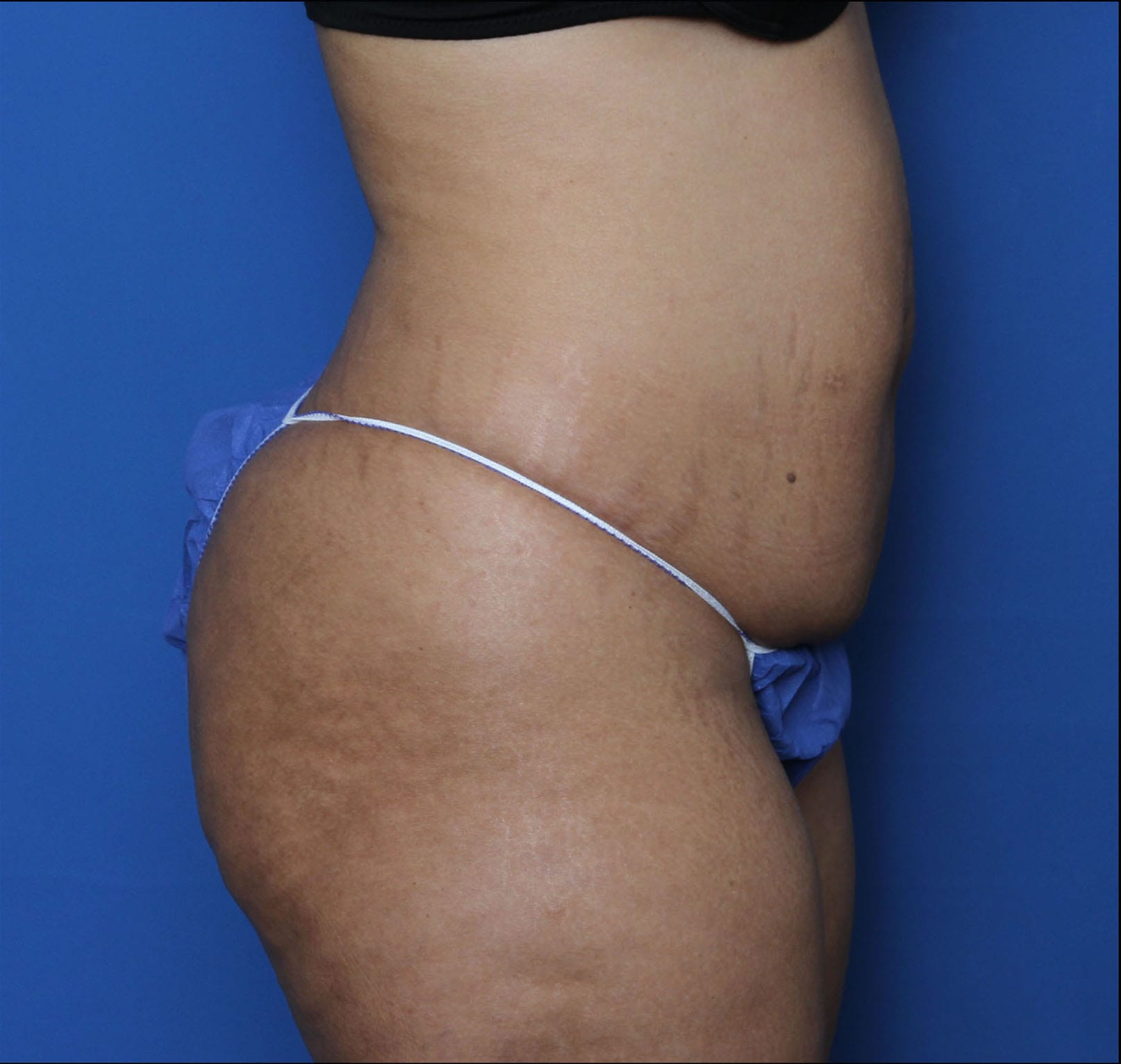 Tummy Tuck Patient Photo - Case MM5921 - before view-1