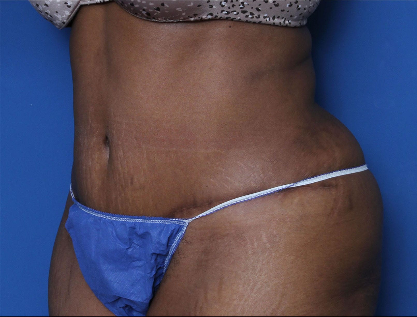 Liposuction Patient Photo - Case MM6000 - after view-1