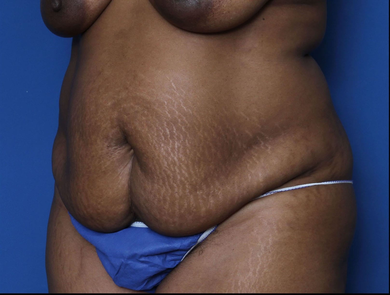 Liposuction Patient Photo - Case MM6000 - before view-1