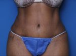 Liposuction - Case MM6000 - After
