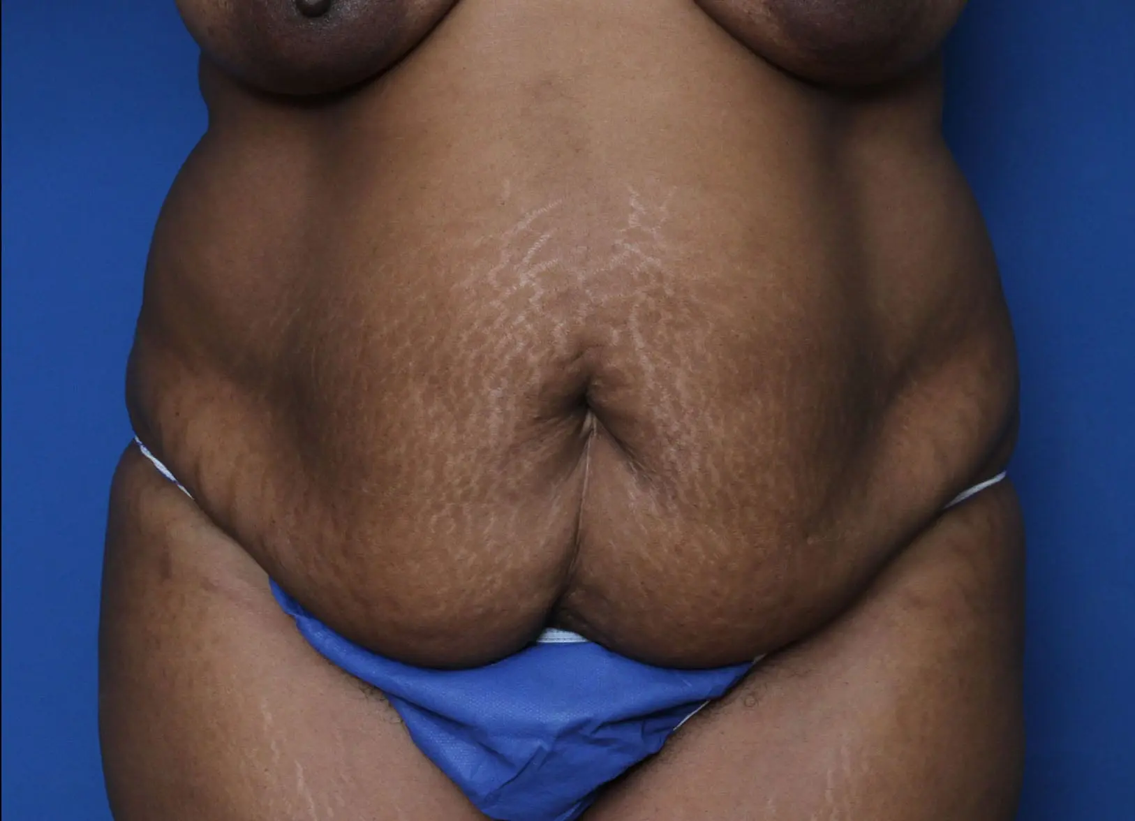 Liposuction Patient Photo - Case MM6000 - before view-