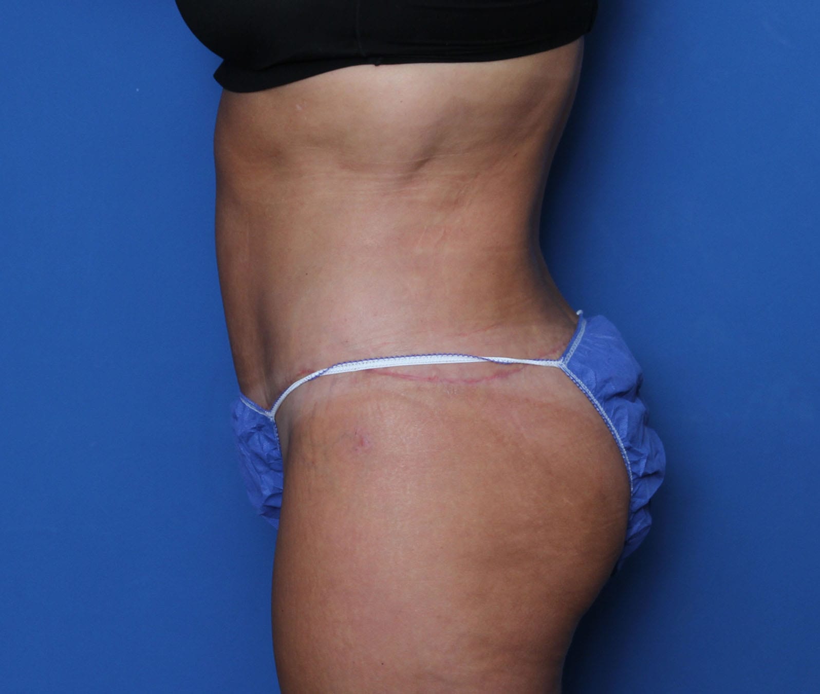 Belt Lipectomy Patient Photo - Case MM6052 - after view-2