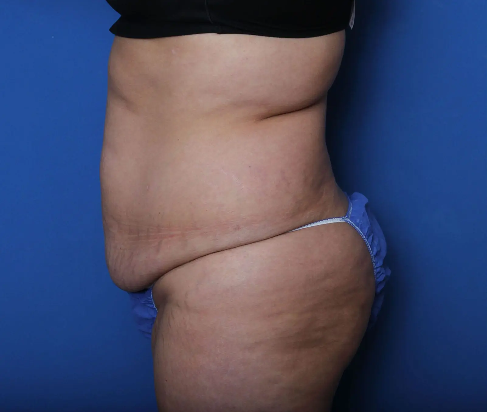 Belt Lipectomy Patient Photo - Case MM6052 - before view-2