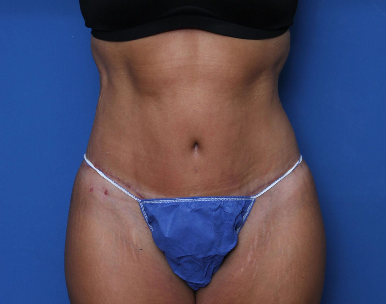 Belt Lipectomy Patient Photo - Case MM6052 - after view-0