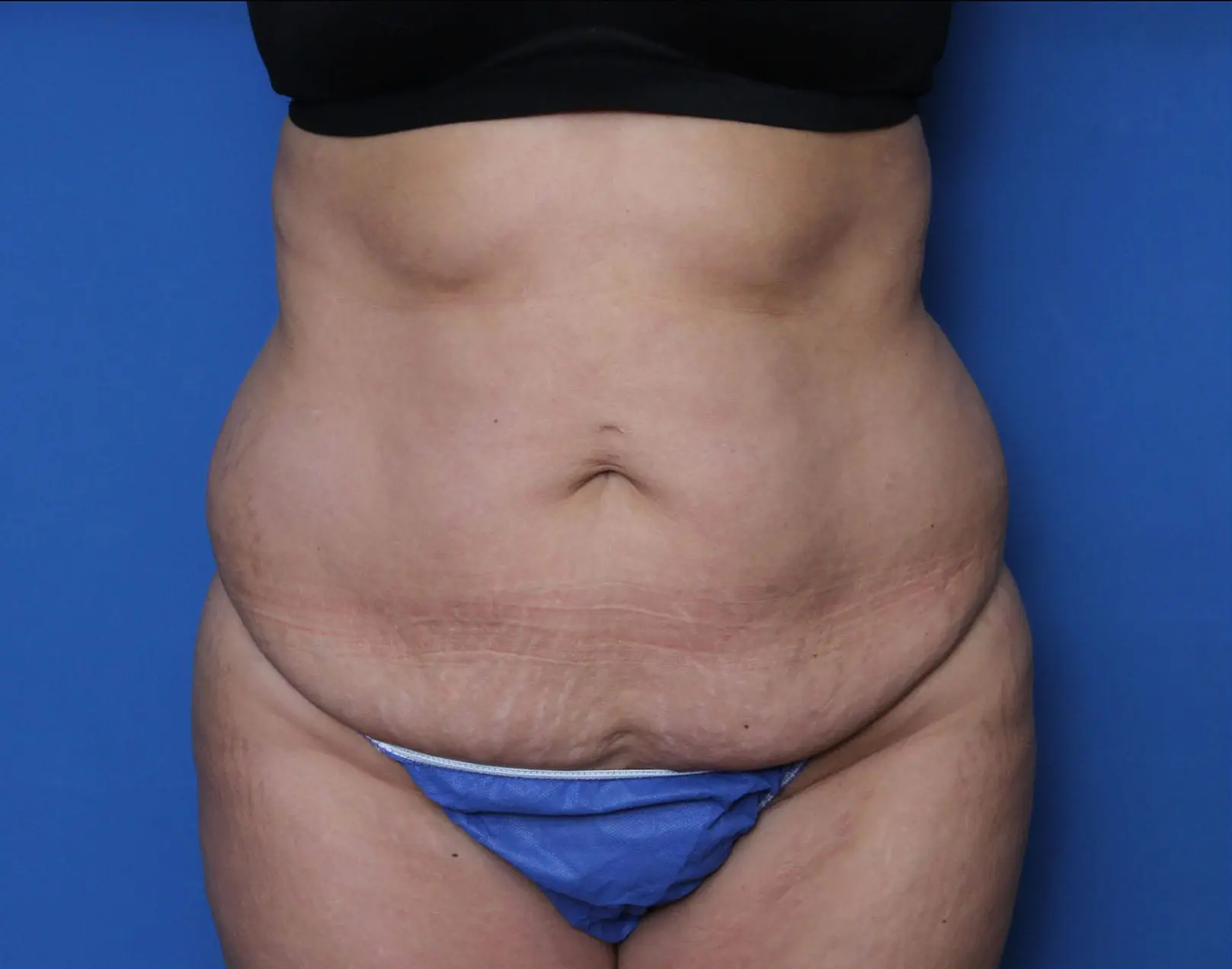 Belt Lipectomy Patient Photo - Case MM6052 - before view-0