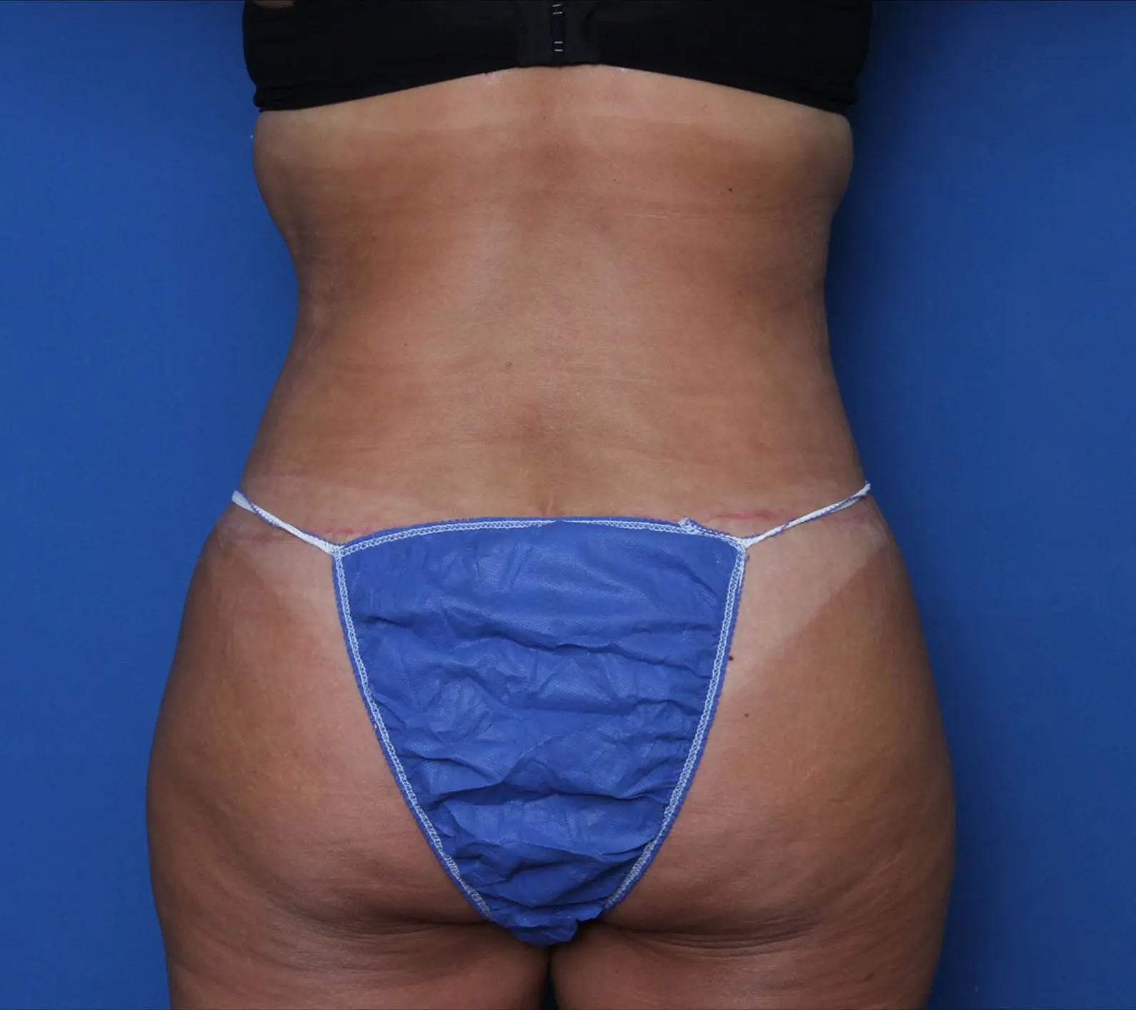 Belt Lipectomy Patient Photo - Case MM6052 - after view-3