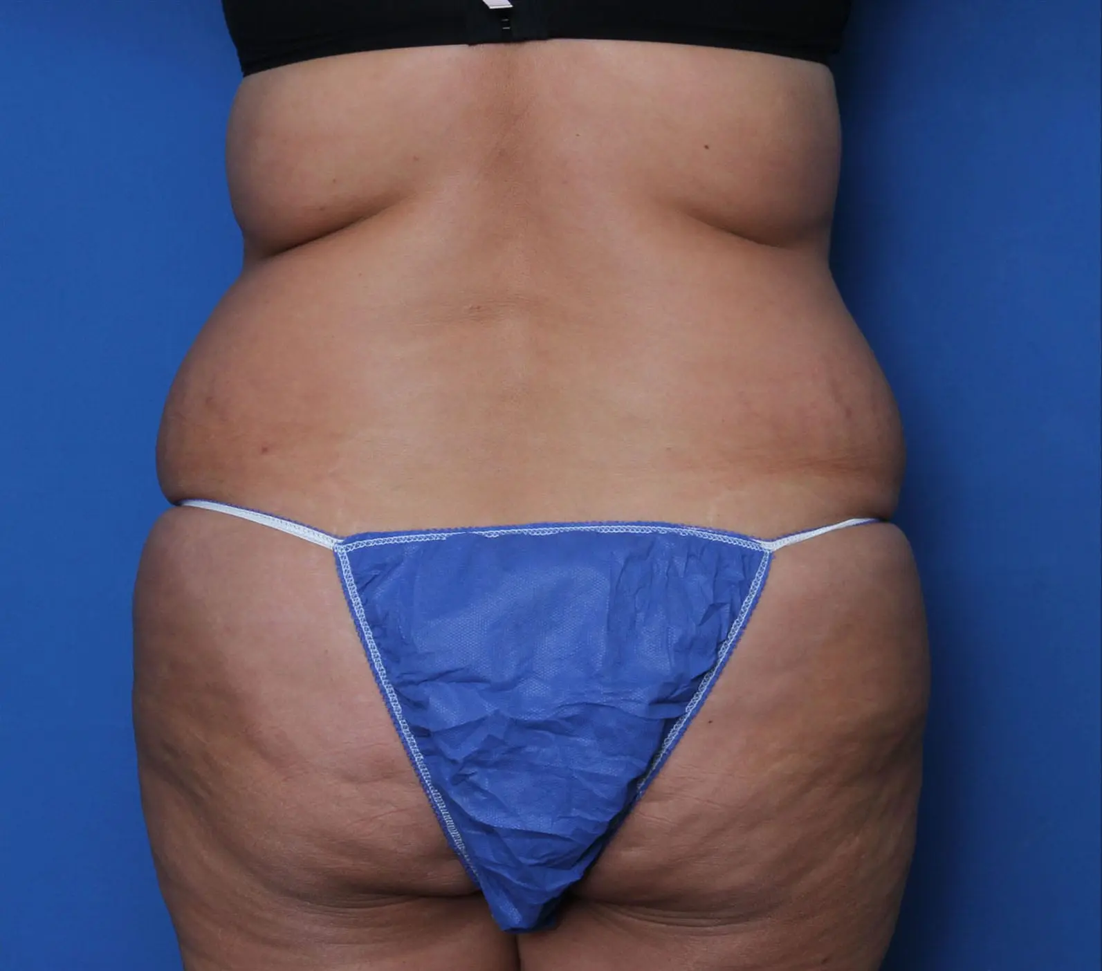 Belt Lipectomy Patient Photo - Case MM6052 - before view-3