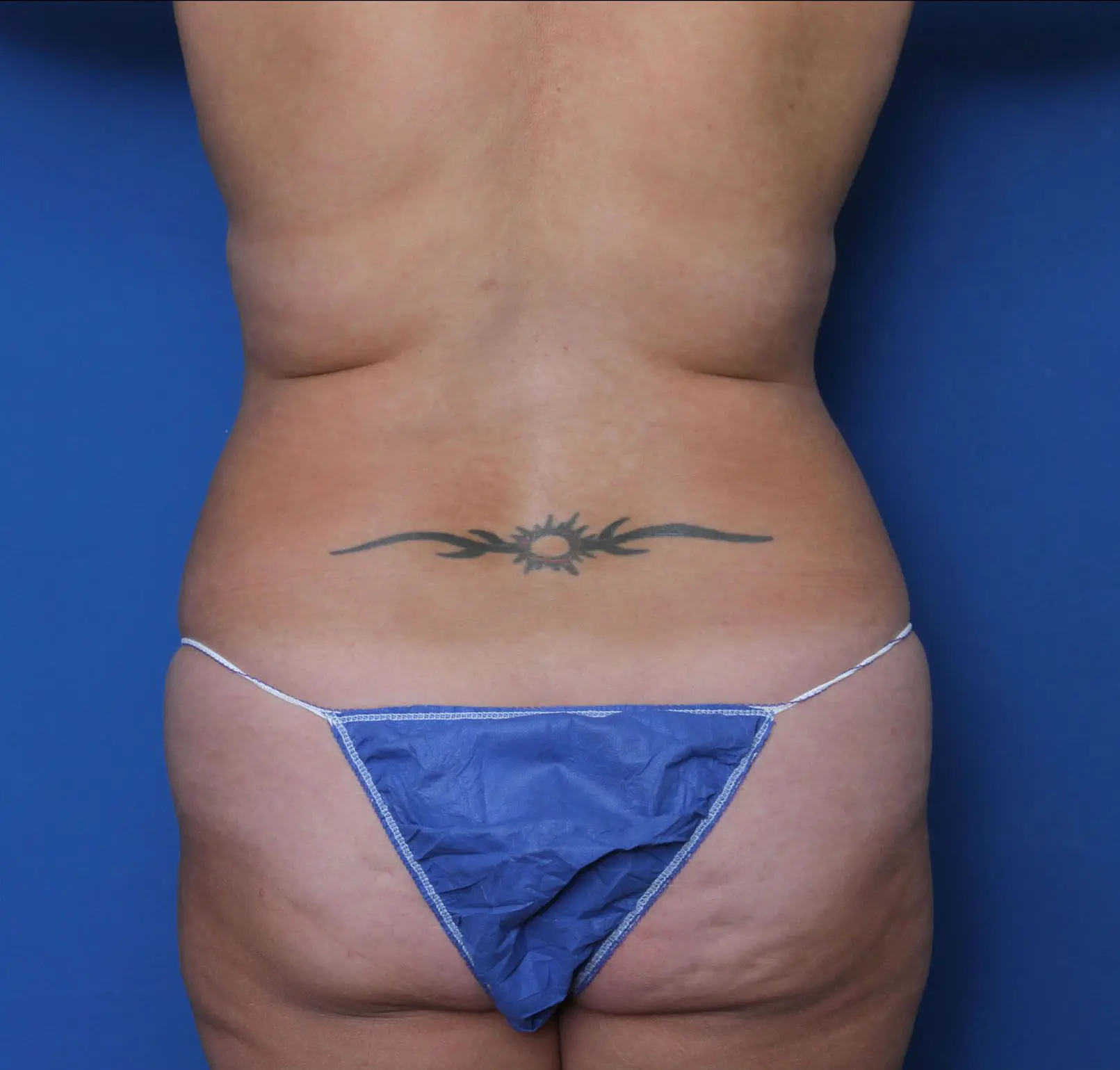 Tummy Tuck Patient Photo - Case 6964 - before view-3