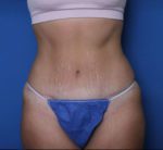 Tummy Tuck - Case 6960 - After