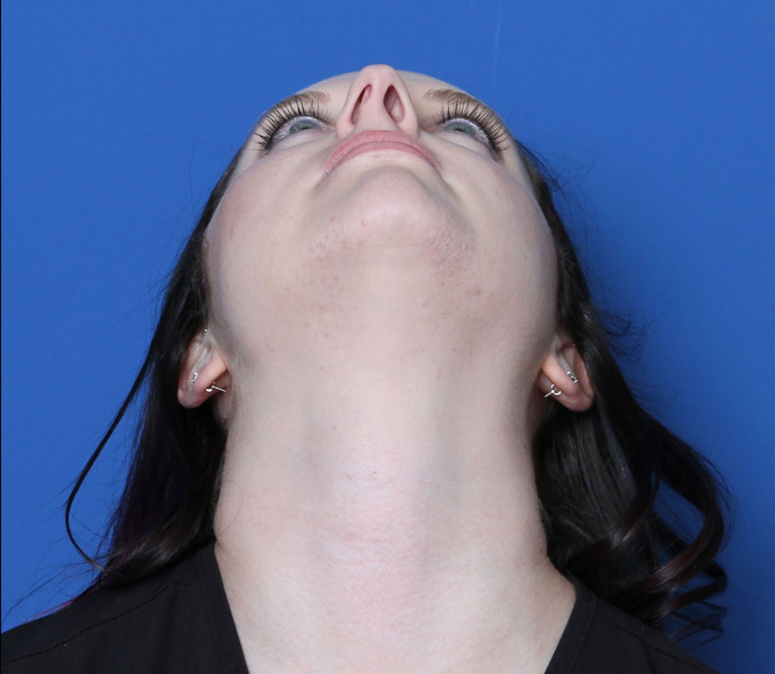 Rhinoplasty Patient Photo - Case 6956 - before view-3
