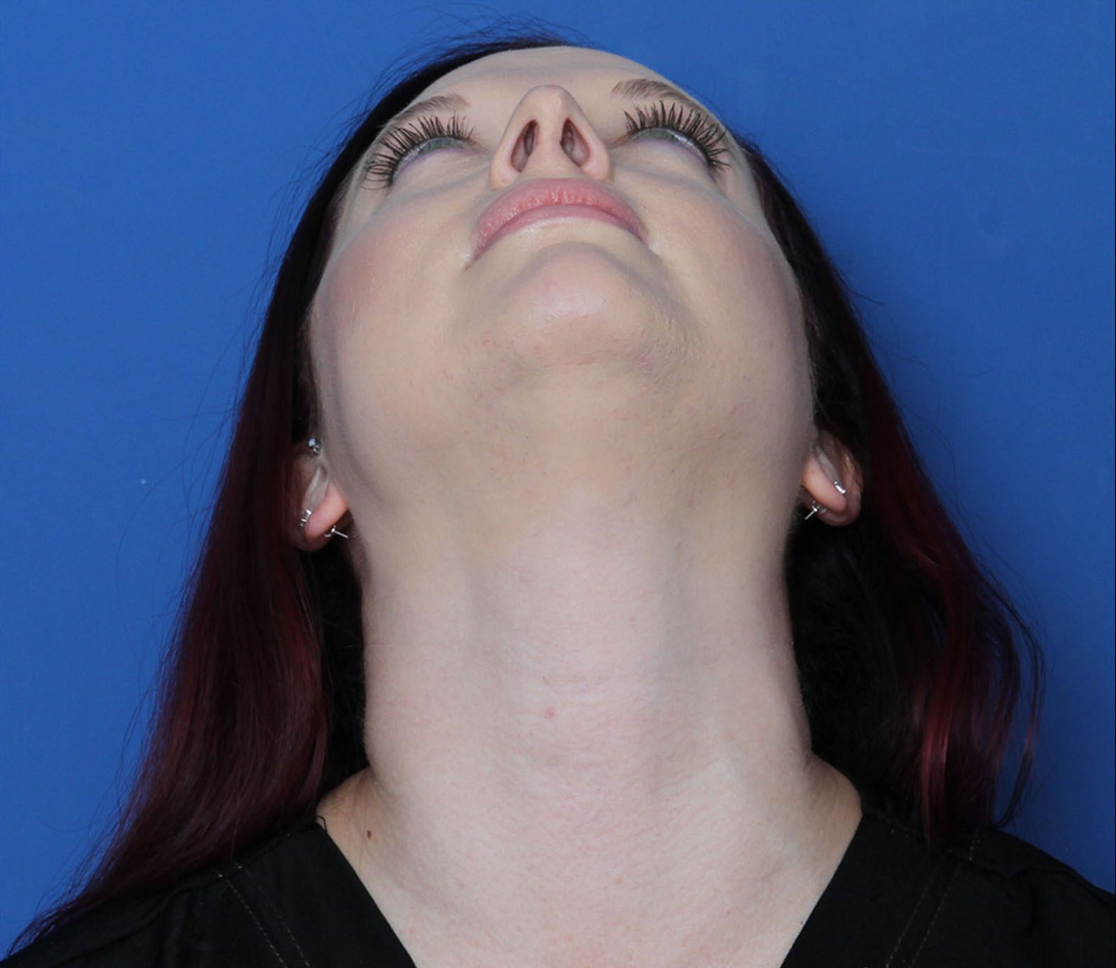 Rhinoplasty Patient Photo - Case 6956 - after view-3