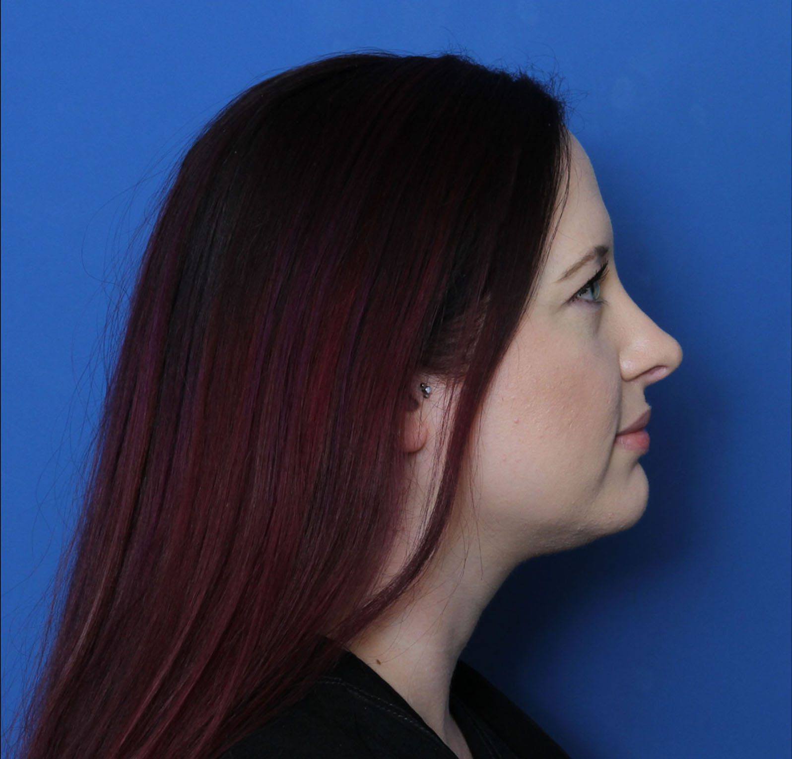 Rhinoplasty Patient Photo - Case 6956 - after view-2