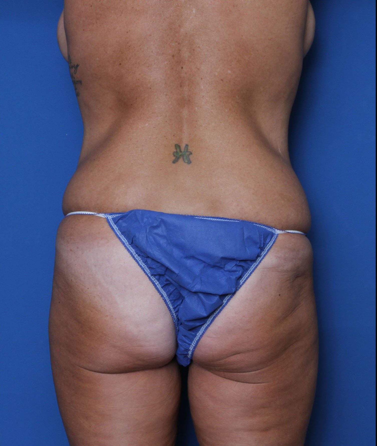 Belt Lipectomy Patient Photo - Case 6958 - before view-3