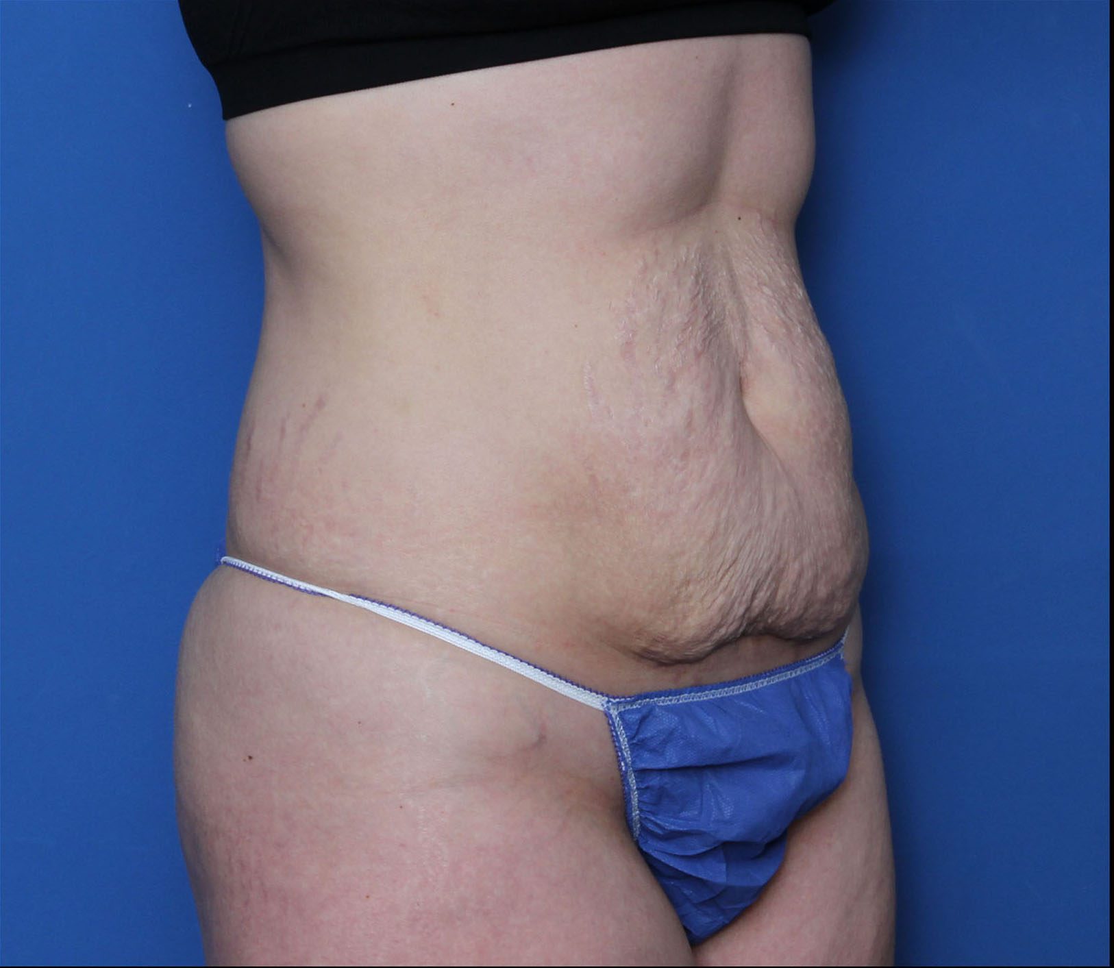 Tummy Tuck Patient Photo - Case 6960 - before view-1