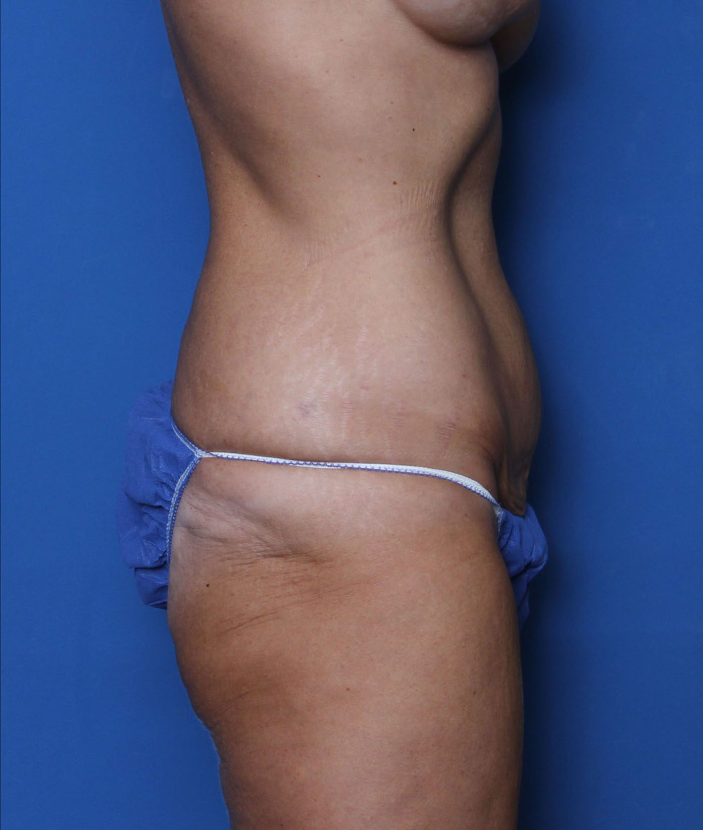 Belt Lipectomy Patient Photo - Case 6958 - before view-2