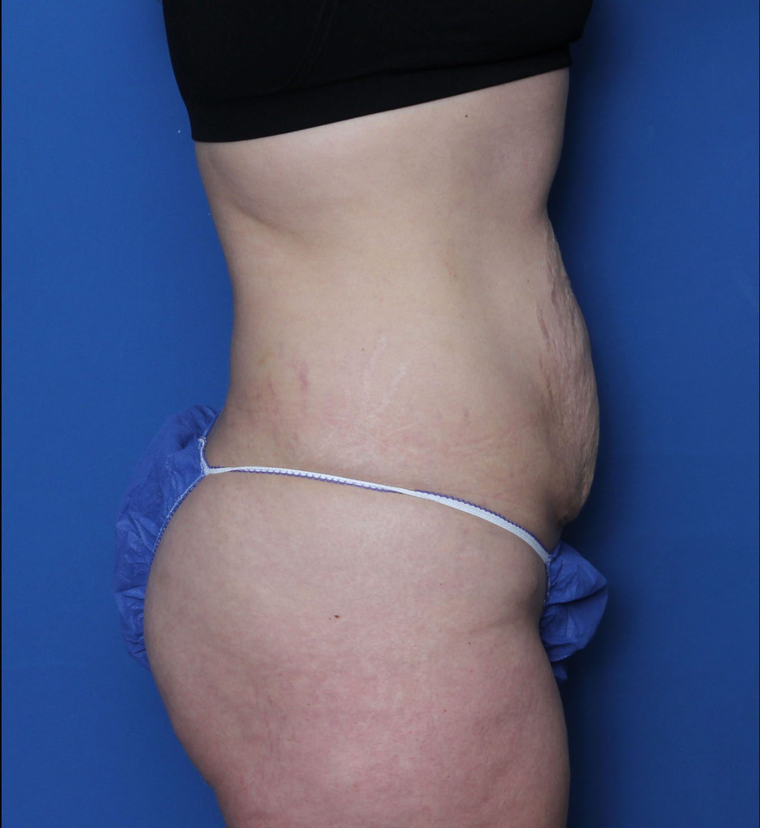 Tummy Tuck Patient Photo - Case 6960 - before view-2