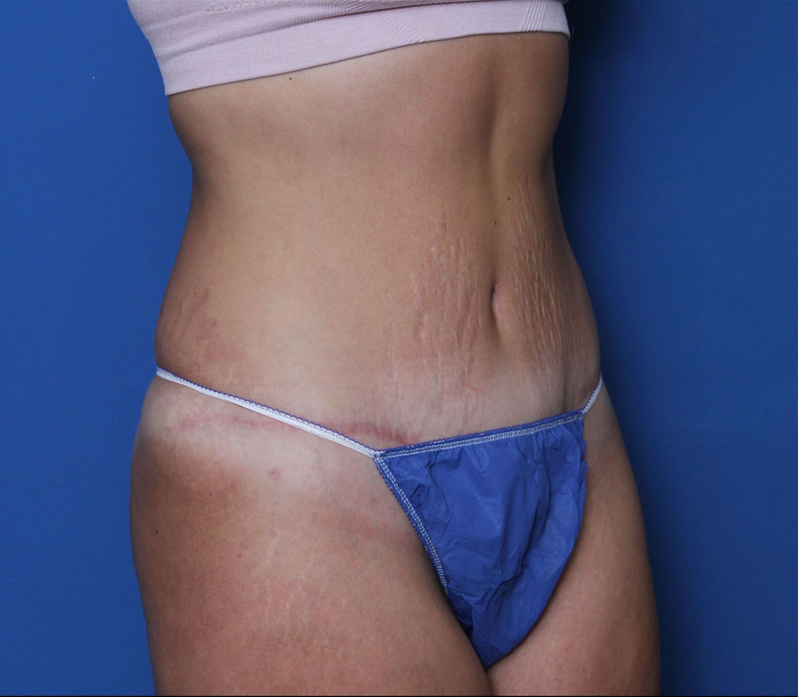 Tummy Tuck Patient Photo - Case 6960 - after view-1