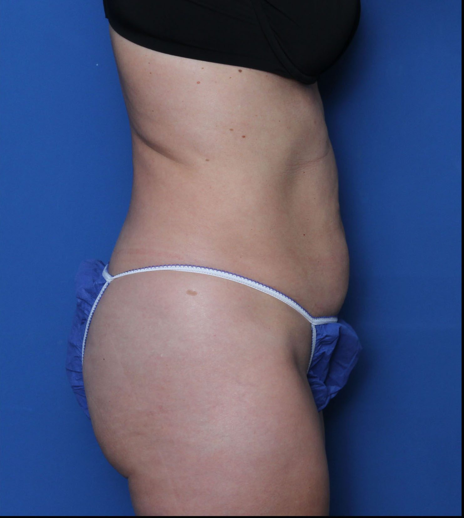 Liposuction Patient Photo - Case 7236 - before view-2