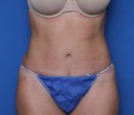Liposuction - Case 7236 - After