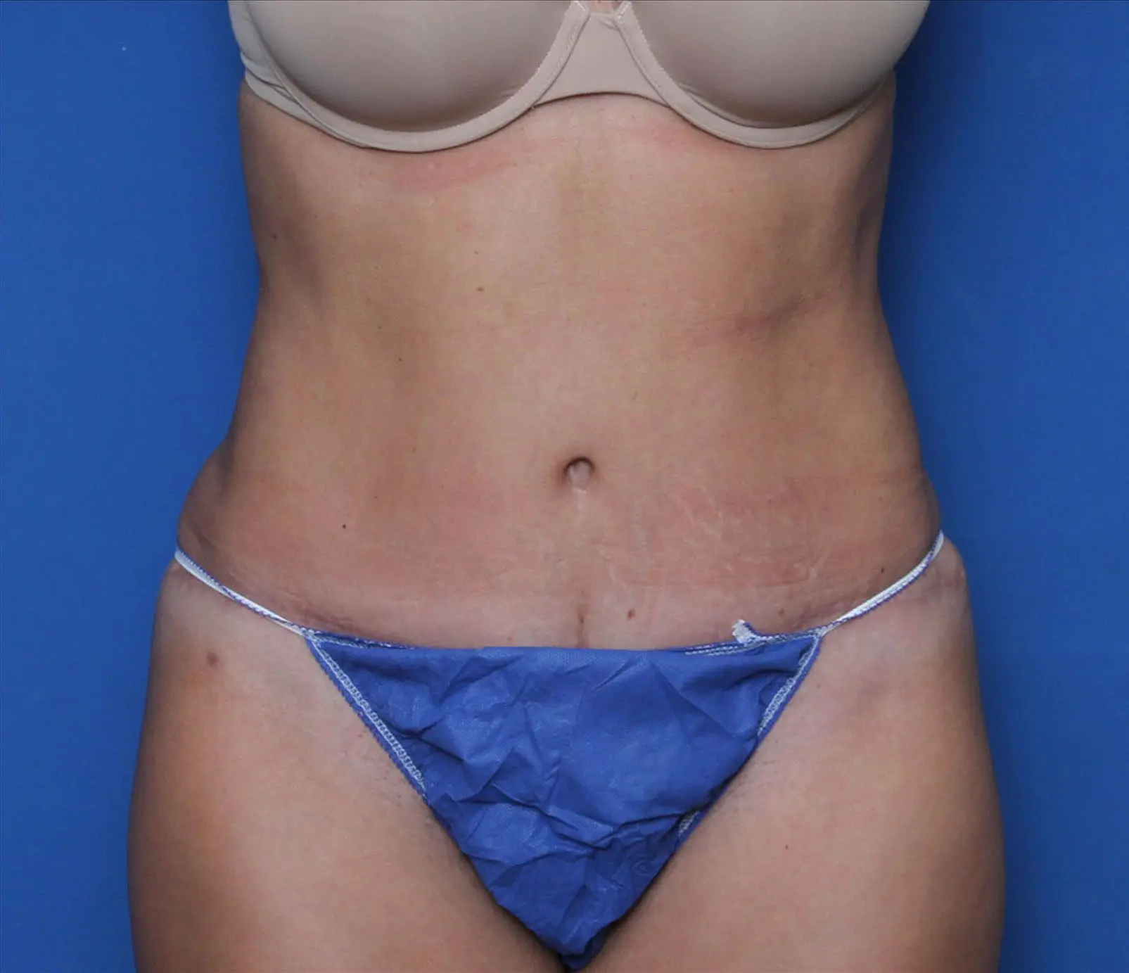 Liposuction Patient Photo - Case 7236 - after view