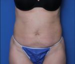 Liposuction - Case 7236 - Before