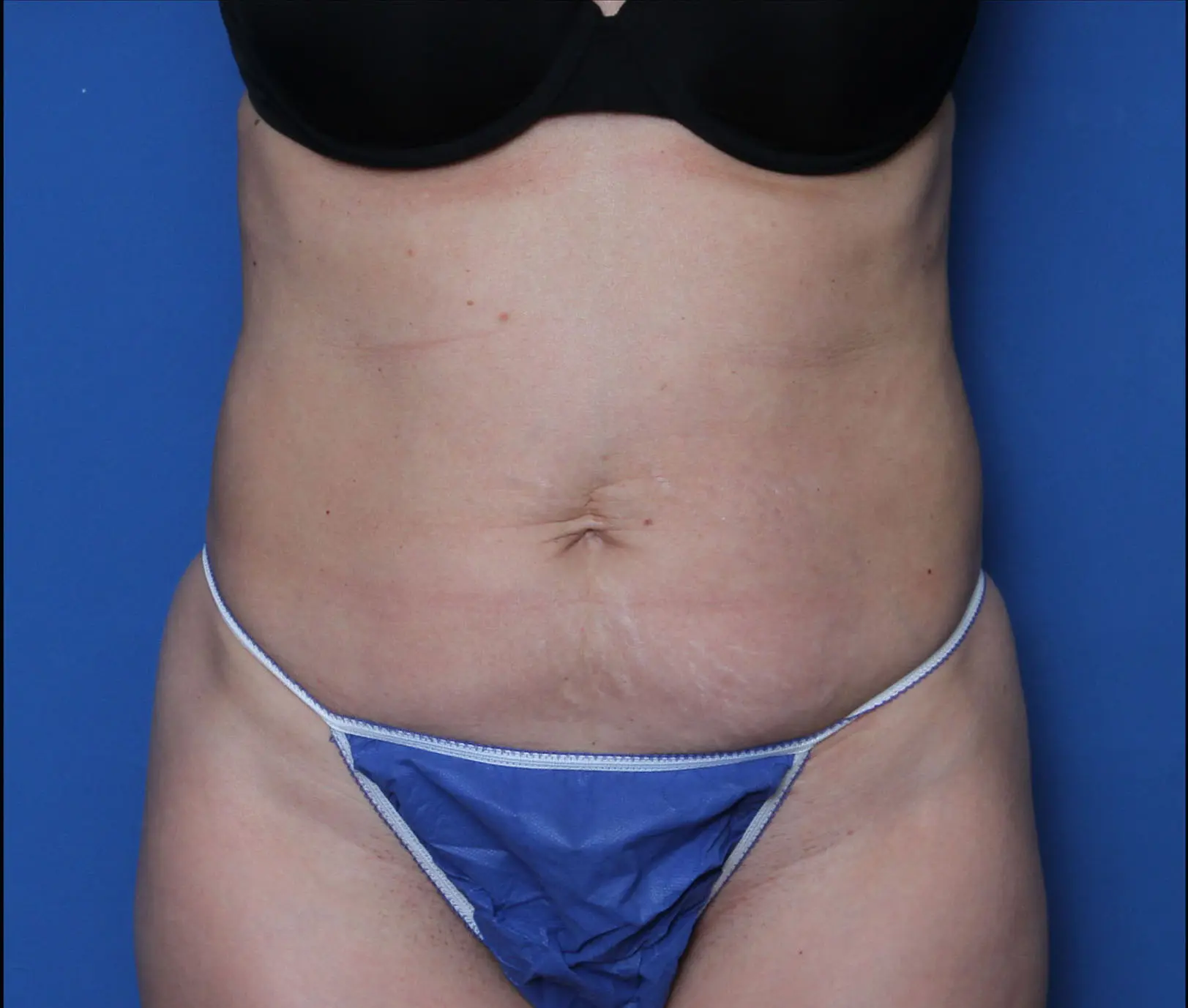 Liposuction Patient Photo - Case 7236 - before view-