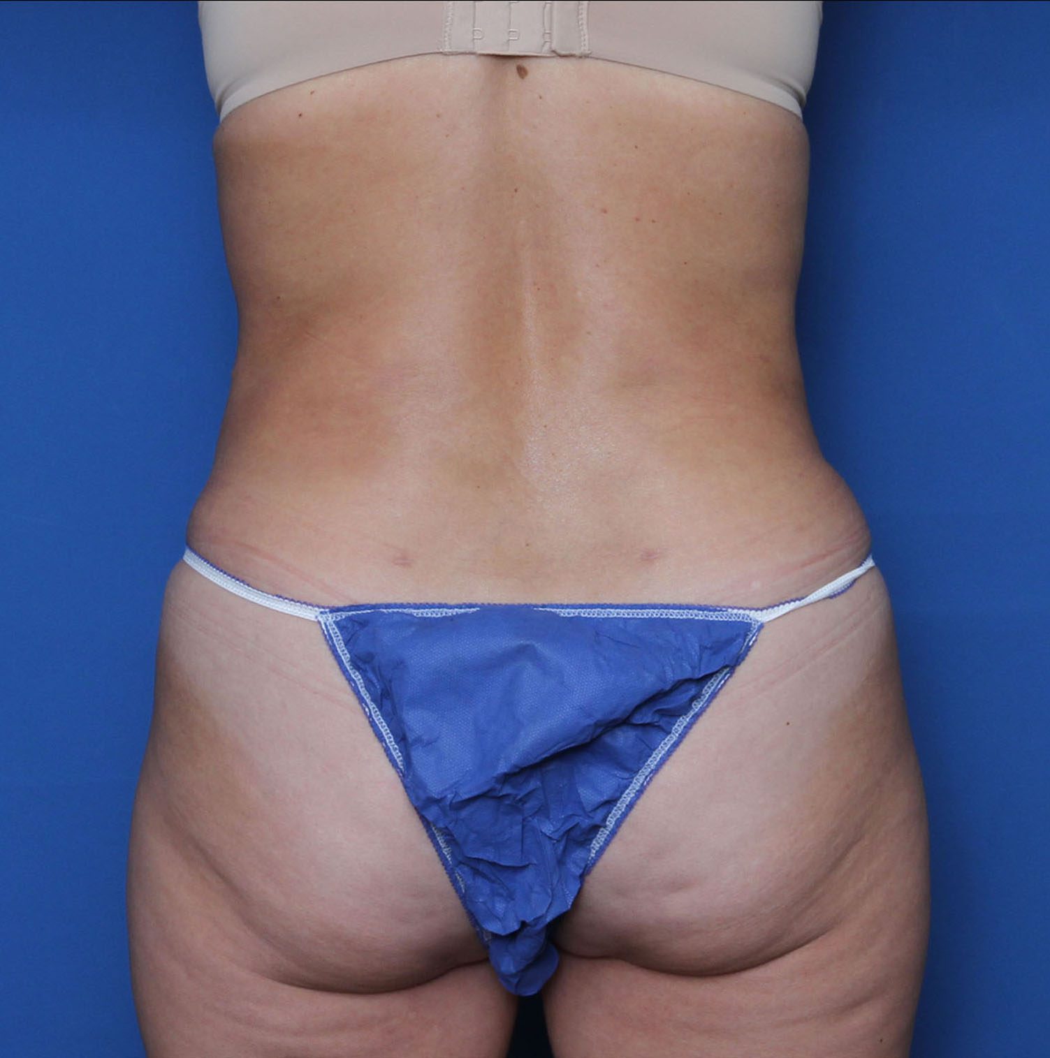 Liposuction Patient Photo - Case 7236 - after view-3