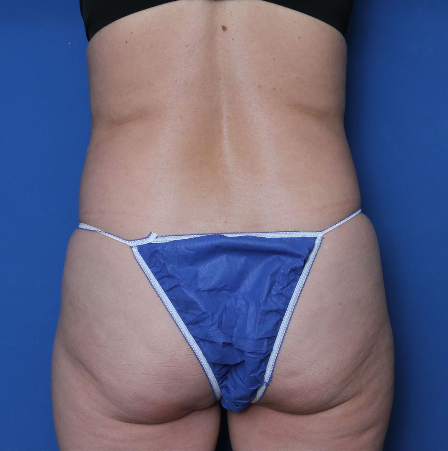 Liposuction Patient Photo - Case 7236 - before view-3