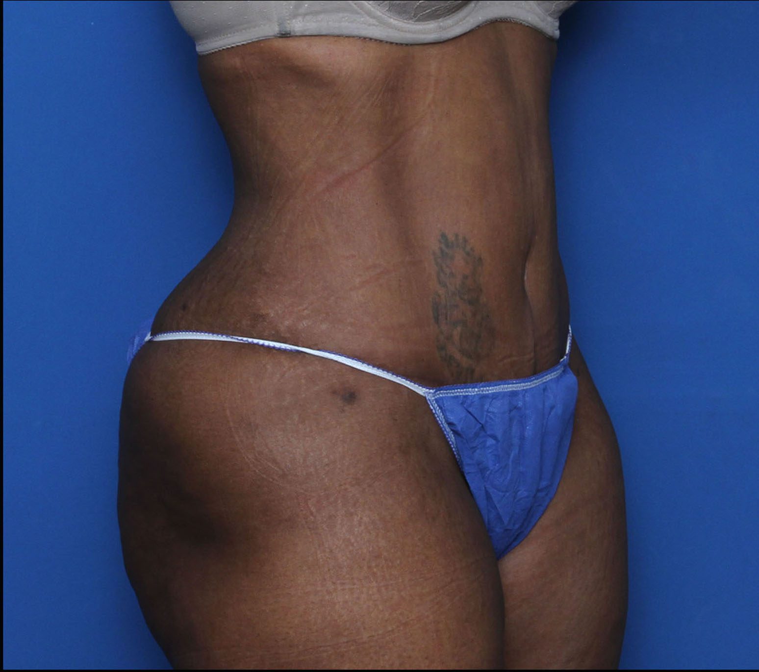 Liposuction Patient Photo - Case 7232 - after view-1