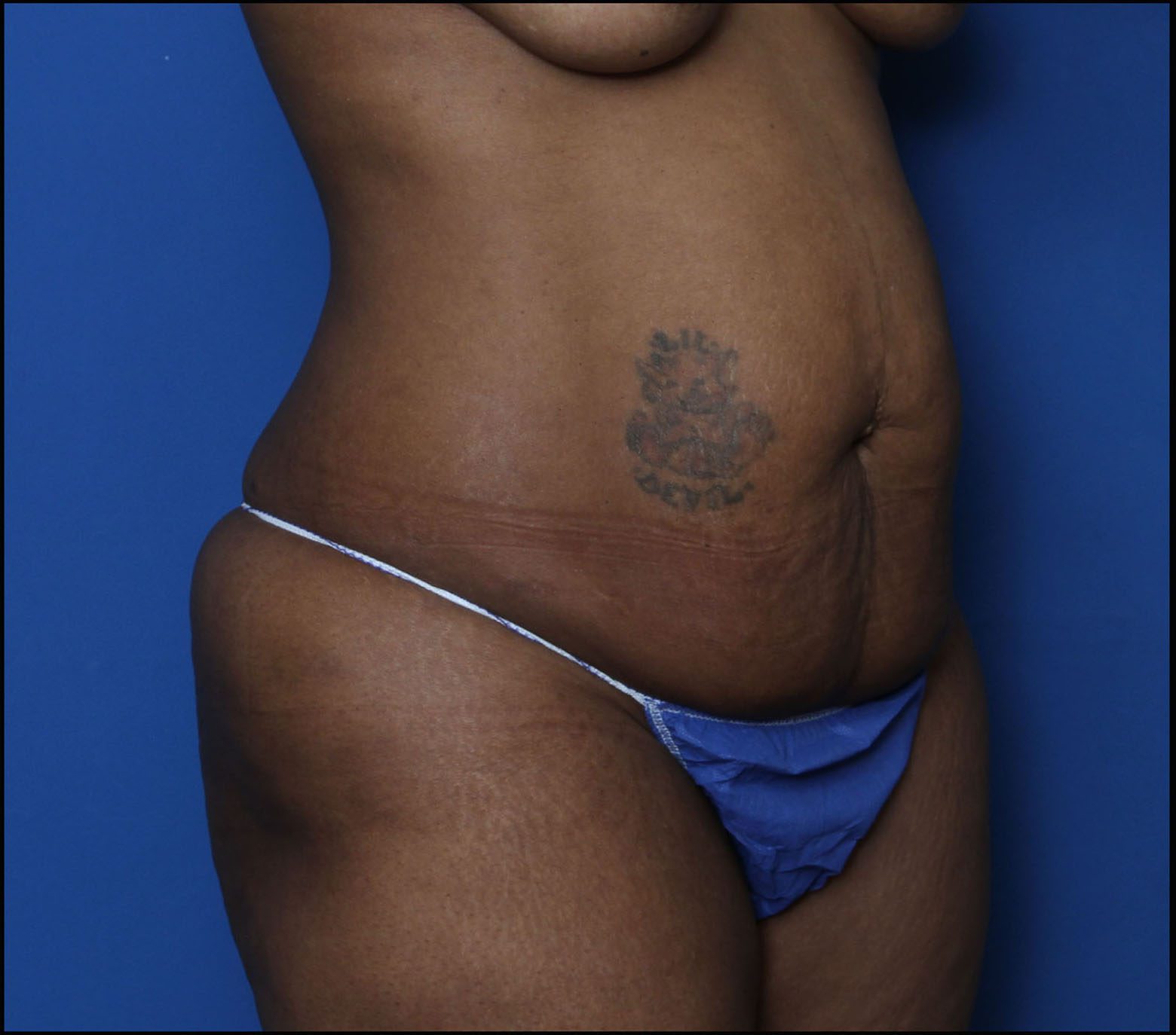 Liposuction Patient Photo - Case 7232 - before view-1