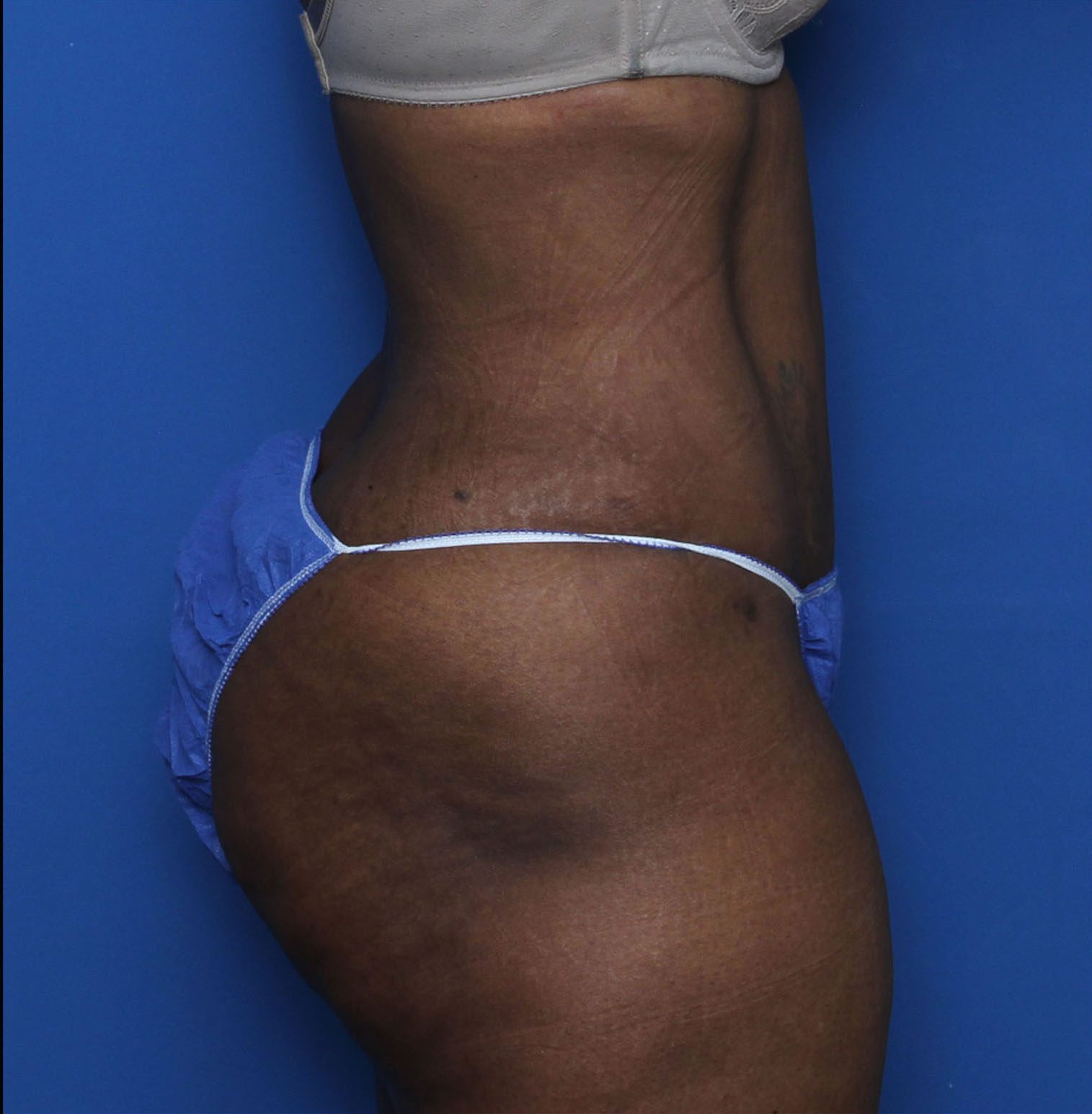 Liposuction Patient Photo - Case 7232 - after view-2