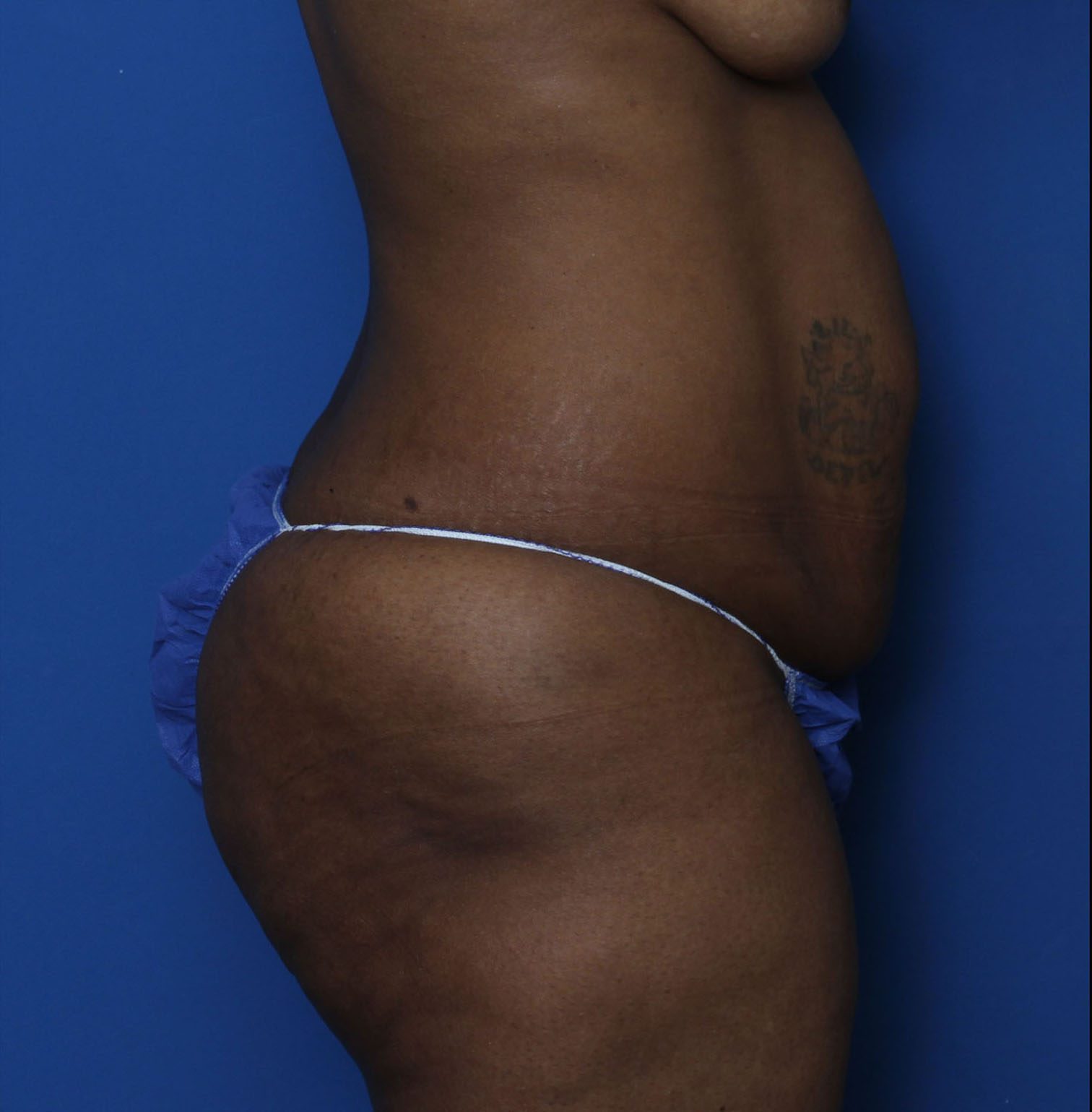 Liposuction Patient Photo - Case 7232 - before view-2